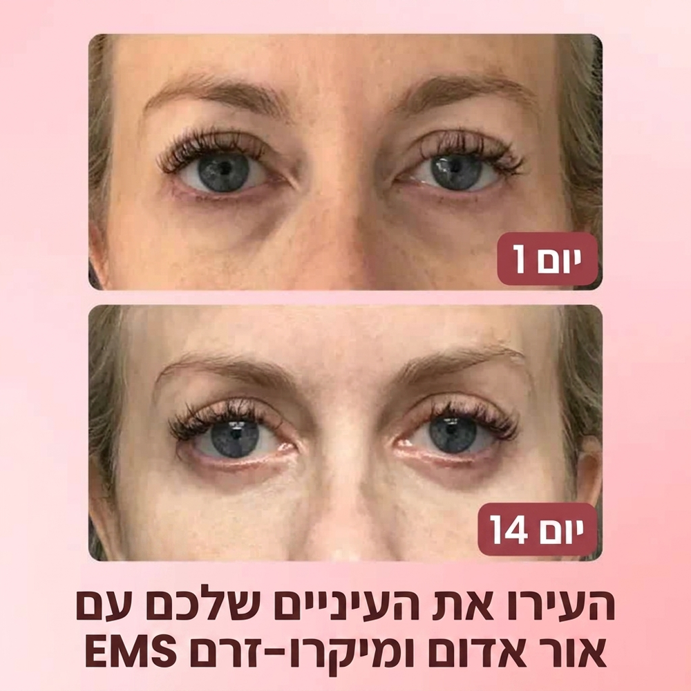 AURIA – פתרון לשקיות מתחת לעיניים